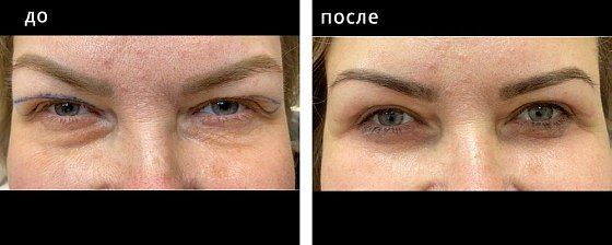 Блефаропластика верх. Мурзаева 03: до и после – фото 2