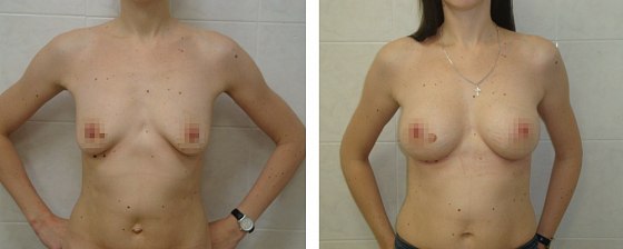 Маммопластика. Еременко В.С._16: до и после – фото 42