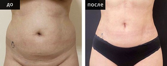 Мурзаева_Высокоточная липоскульптура: до и после – фото 11
