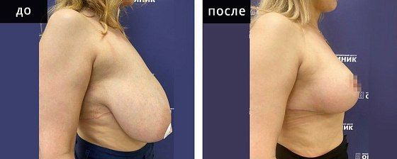 Подтяжка груди. Мурзаева 24: до и после – фото 14