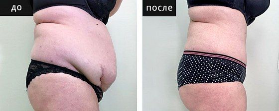 Липосакция живота. Зварич 03: до и после – фото 6