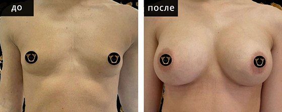 Маммопластика аугментационная. Гусляков 14: до и после – фото 22