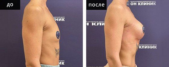Маммопластика аугментационная. Зварич 09: до и после – фото 32