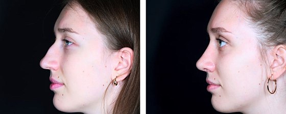 Ринопластика: до и после – фото 18