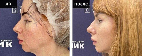 Лифтинг лица: до и после – фото 13