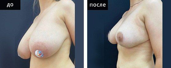 Подтяжка груди. Мурзаева 09: до и после – фото 12