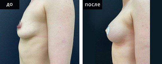 Увеличение груди. Мурзаева 14: до и после – фото 13