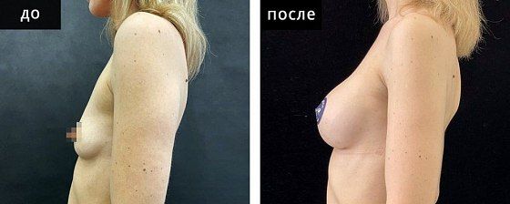 Маммопластика аугментационная. Зварич 05: до и после – фото 28