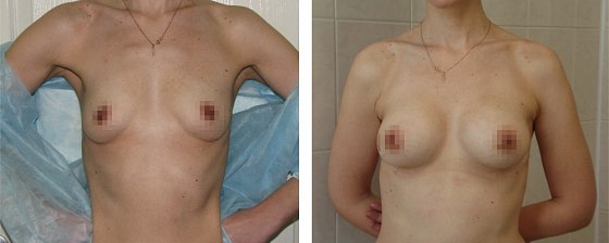 Маммопластика: до и после – фото 32
