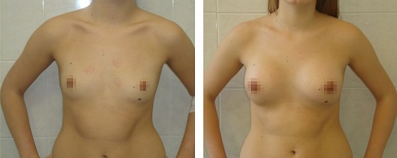Маммопластика. Еременко В.С._11: до и после – фото 8