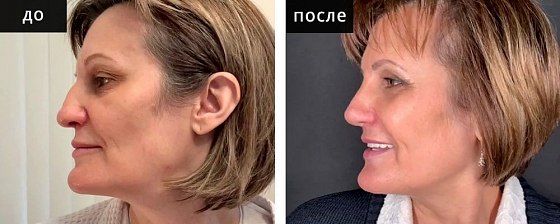 Ринопластика: до и после – фото 17