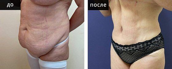 Абдоминопластика и липофилинг. Мурзаева 02: до и после – фото 2