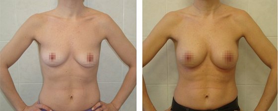 Маммопластика. Еременко В.С._14: до и после – фото 8