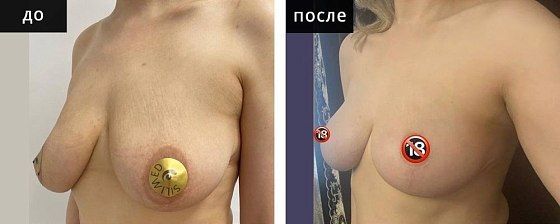 Подтяжка груди. Мурзаева 07: до и после – фото 12