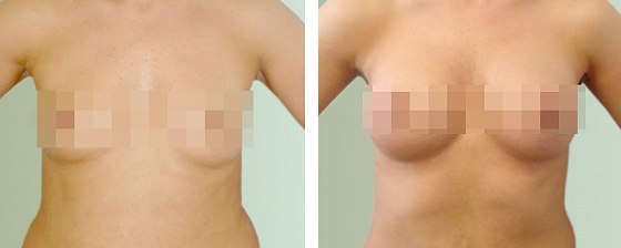 Маммопластика: до и после – фото 6