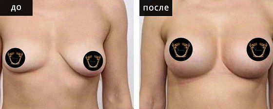 Маммопластика аугментационная. Гусляков 07: до и после – фото 15