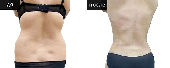 Мурзаева_Высокоточная липоскульптура: до и после – фото 8