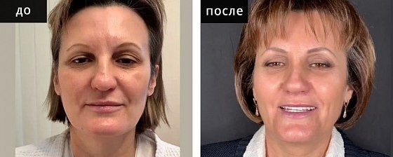 Ринопластика: до и после – фото 23