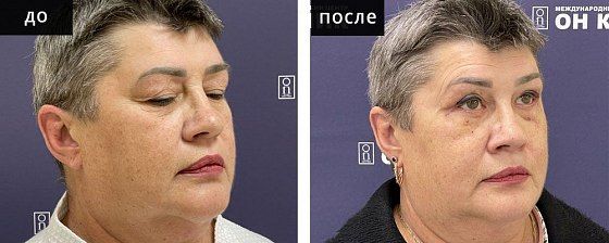 Блефаропластика круговая. Миопексия. Зварич 03: до и после – фото 38