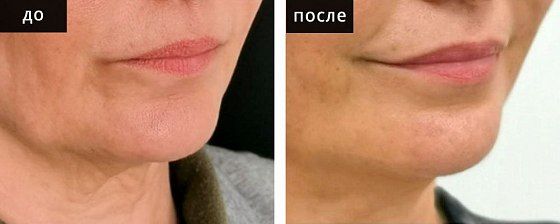 Пластика губ. Глебова 04: до и после – фото 1