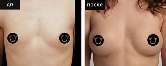 Маммопластика аугментационная. Гусляков 04: до и после – фото 12