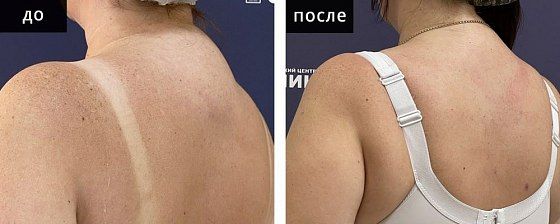 Липосакция: фото до и после: до и после – фото 11