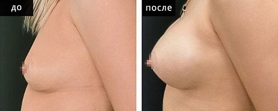 Маммопластика - увеличение груди. Глебова 01: до и после – фото 6
