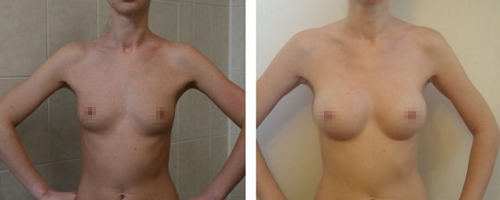Маммопластика: до и после – фото 12