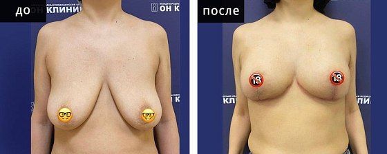 Подтяжка груди. Мурзаева 04: до и после – фото 10