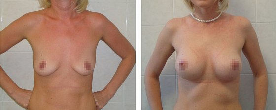 Маммопластика: до и после – фото 44