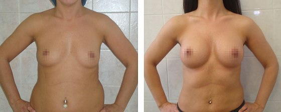 Маммопластика: до и после – фото 40