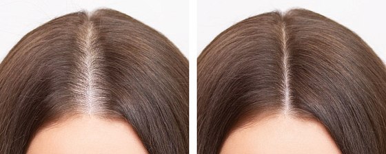 Плазмолифтинг кожи головы: до и после – фото 1