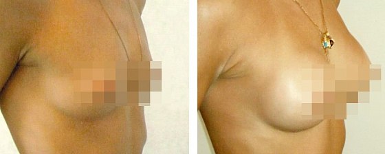 Маммопластика. Короткий И.В.: до и после – фото 36