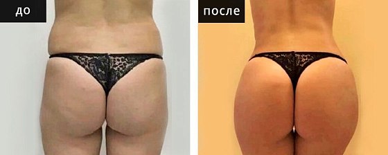 Липоскульптура. Липосакция. Гусляков 01: до и после – фото 1