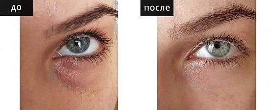Контурная пластика области глаз. Мельниченко 12: до и после – фото 2
