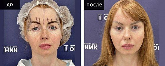 Лифтинг лица: до и после – фото 9