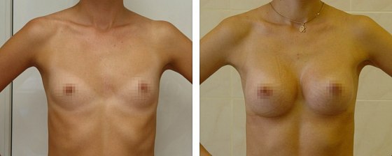 Маммопластика: до и после – фото 38