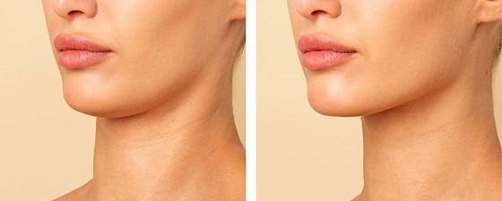 Ментопластика 05: до и после – фото 5
