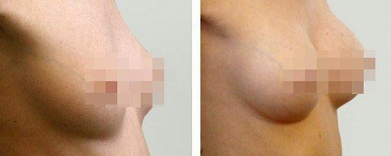 Маммопластика: до и после – фото 30