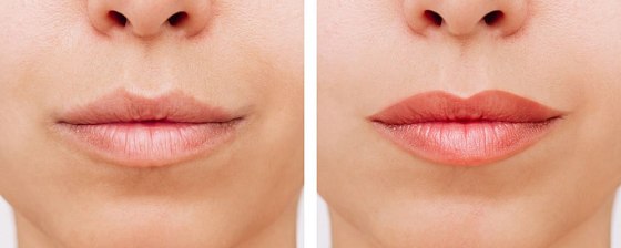 Контурная пластика губ: до и после – фото 1
