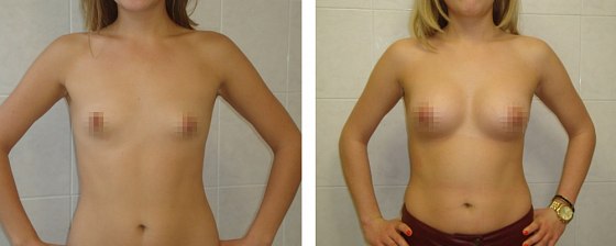 Маммопластика: до и после – фото 19