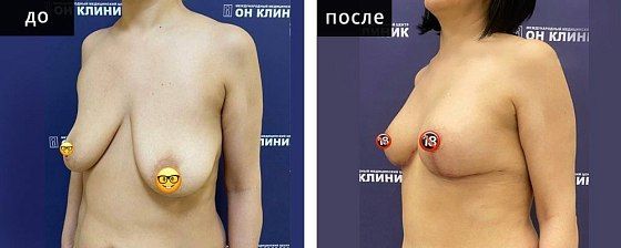 Подтяжка груди. Мурзаева 05: до и после – фото 9