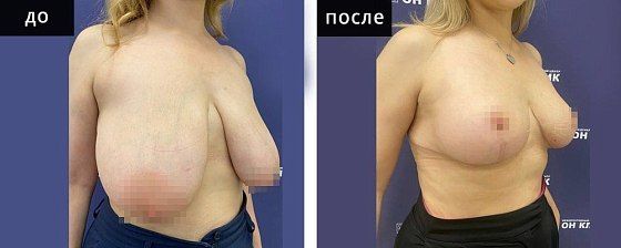 Подтяжка груди. Мурзаева 23: до и после – фото 13