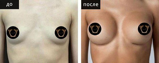 Маммопластика аугментационная. Гусляков 09: до и после – фото 17