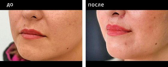Пластика губ. Глебова 06: до и после – фото 3