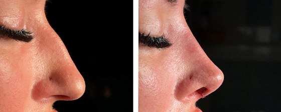 Риносептопластика. Ким 04: до и после – фото 30