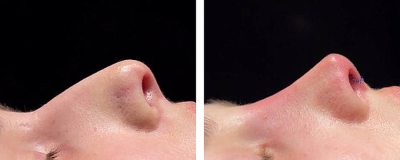 Ринопластика: до и после – фото 28