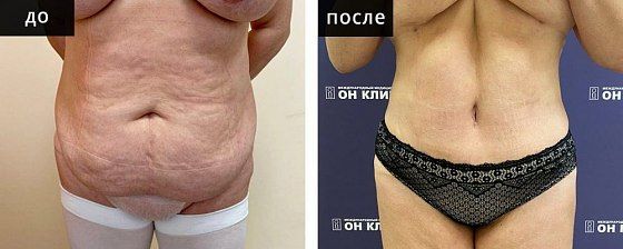 Абдоминопластика и липофилинг. Мурзаева 01: до и после – фото 3