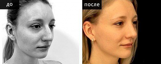 Ринопластика: до и после – фото 35