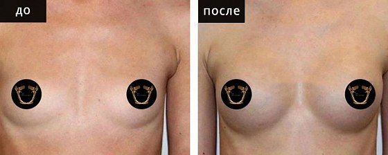Маммопластика аугментационная. Гусляков 12: до и после – фото 20